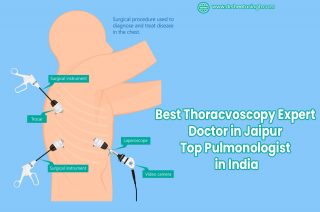 Best Thoracoscopy Expert Doctor in Jaipur
