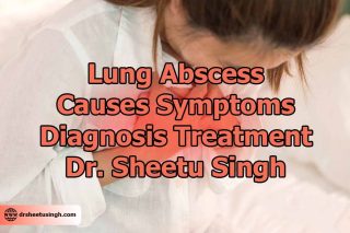 Lung Abscess Causes, Symptoms, Diagnosis, Treatment - Dr. Sheetu Singh