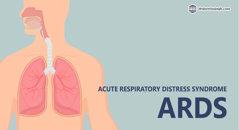 What is Acute Respiratory Distress Syndrome? – Dr. Sheetu Singh