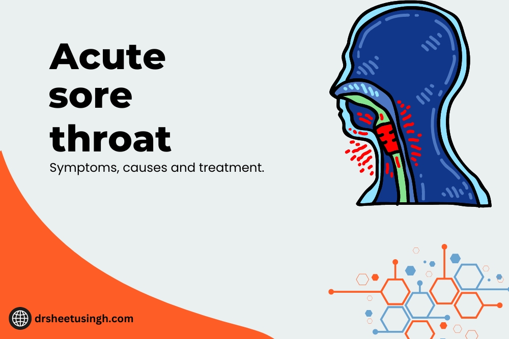 Acute sore throat Symptoms, causes and treatment
