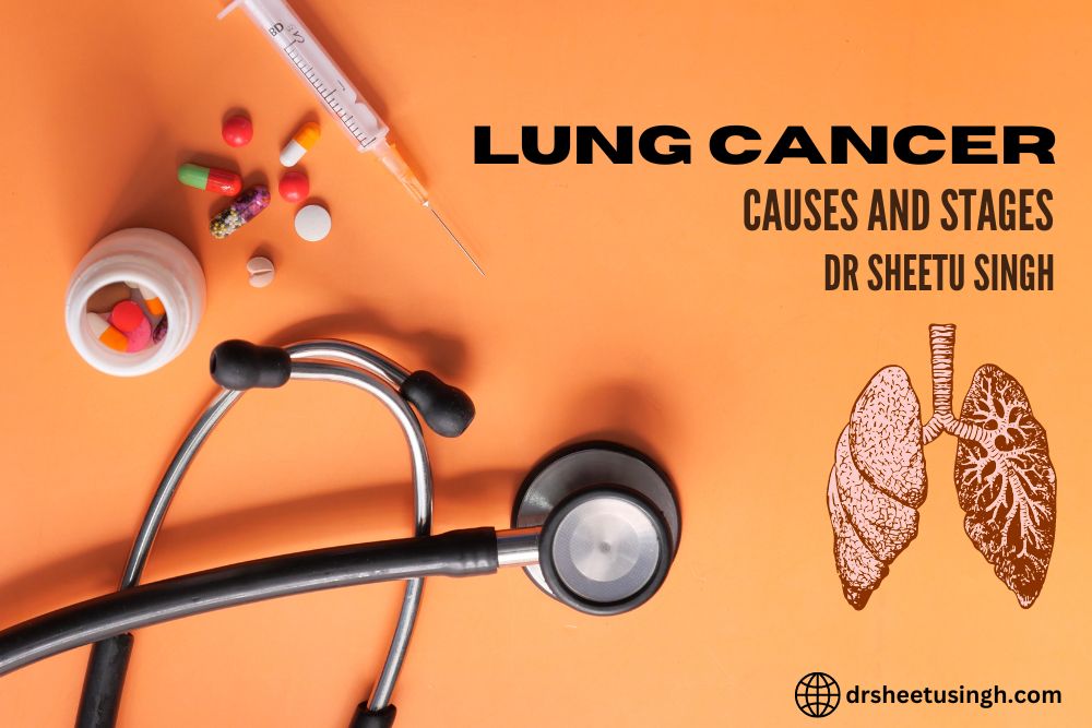 Lung Cancer Causes and Stages