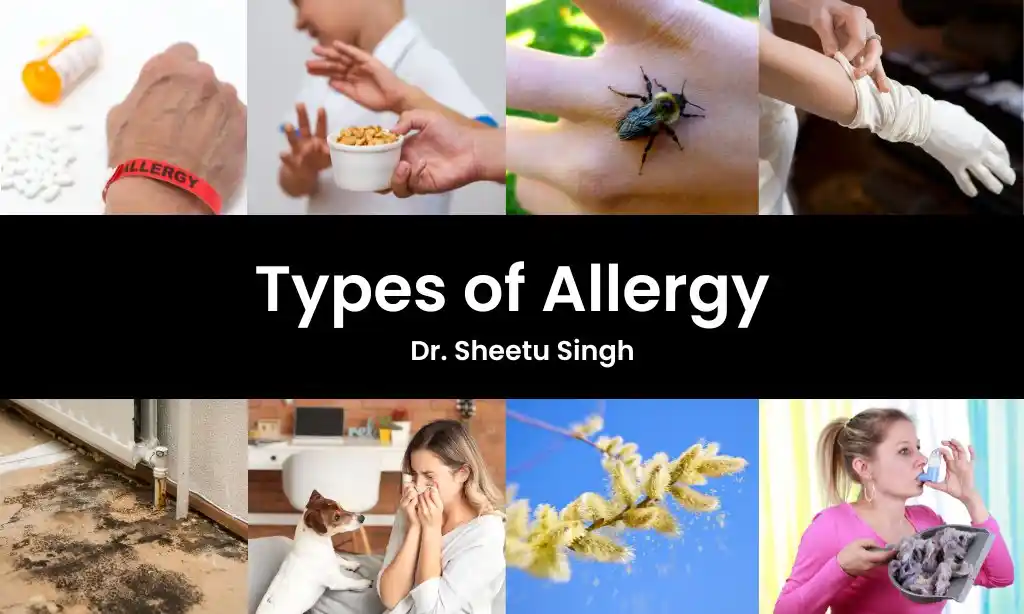 Types of Allergy - Dr. Sheetu Singh