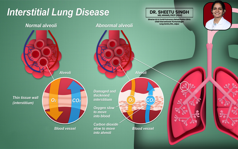 Research-and-Advances-in-Interstitial-Lung-Disease.jpg